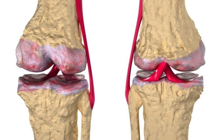 Arthrose des Kniegelenks