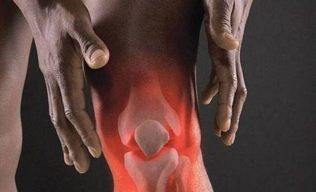 Arthrose geht mit einem entzündlichen Prozess im Kniegelenk einher